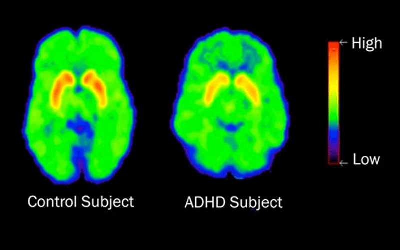 تفاوت مغز افراد مبتلا به ADHD اختلال نقص توجه با مغز سالم